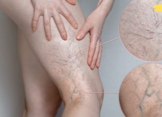 მოიშორეთ სისხლძარღვები ფეხებიდან წამლებისა და ოპერაციის გარეშე! ძალიან ეფექტური მეთოდია!!