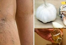 აი როგორ ამცირებს ნივრის ზეთი ვარიკოზული ვენების ანთებას!