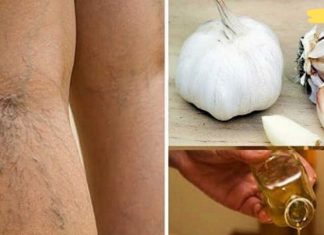 აი როგორ ამცირებს ნივრის ზეთი ვარიკოზული ვენების ანთებას!