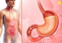 კუჭის წყლულის სამკურნალო რეცეპტი ხალხური მედიცინის წიგნაკიდან!