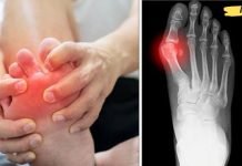 პოდაგრას მოცილება ბუნებრივი მეთოდებით შესაძლებელია. აი რა უნდა გააკეთოთ ამისთვის!