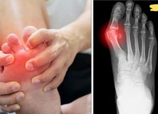 პოდაგრას მოცილება ბუნებრივი მეთოდებით შესაძლებელია. აი რა უნდა გააკეთოთ ამისთვის!