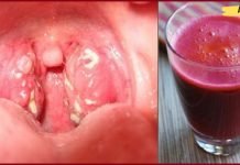 როგორ მოვიშოროთ ყელის ინფექციები სულ რაღაც 4 საათში? ბუნებრივი მკურნალობა!