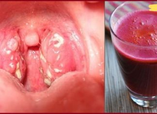 როგორ მოვიშოროთ ყელის ინფექციები სულ რაღაც 4 საათში? ბუნებრივი მკურნალობა!