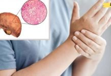 რა იწვევს ღვიძლის ცხიმოვან დაავადებას და ხართ თუ არა რისკის ქვეშ?