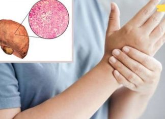 რა იწვევს ღვიძლის ცხიმოვან დაავადებას და ხართ თუ არა რისკის ქვეშ?