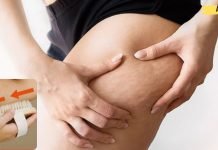 ერთი მარტივი მეთოდი ცელულიტის მოსაშორებლად და ლიმფური სისტემის გასაუმჯობესებლად!