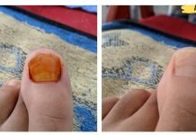 სამუდამოდ დაივიწყეთ სოკო, ამ რეცეპტების წყალობით!