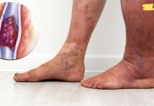 8 ნიშანი იმისა, რომ შესაძლოა სისხლის შედედება გქონდეთ! ყურადღებით იყავით!