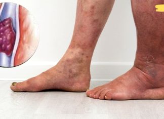 8 ნიშანი იმისა, რომ შესაძლოა სისხლის შედედება გქონდეთ! ყურადღებით იყავით!