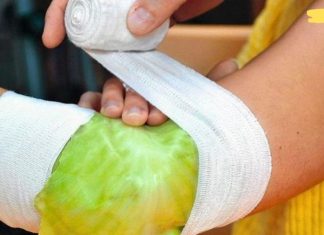 დამწვრობის, ჩირქოვანი ჭრილობების, წყლულების და ნაწოლების დროს გამოიყენეთ კომბოსტოს ფოთოლი! უებარია!