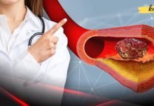 რა საკვები ათხელებს სისხლს? როგორ ავიცილოთ თავიდან თრომბოზი? ეს აუცილებლად უნდა იცოდეთ!