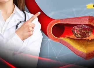 რა საკვები ათხელებს სისხლს? როგორ ავიცილოთ თავიდან თრომბოზი? ეს აუცილებლად უნდა იცოდეთ!