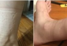 წინდების კვალი ფეხებზე: რას მეტყველებენ ისინი თქვენს ჯანმრთელობაზე?