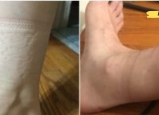 წინდების კვალი ფეხებზე: რას მეტყველებენ ისინი თქვენს ჯანმრთელობაზე?