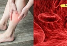 აუცილებლად წაიკითხეთ! ეს სიმპტომებია, რომლებიც შეიძლება მიუთითებდეს სისხლის შედედებაზე!