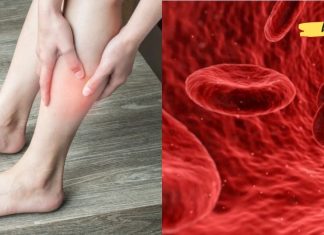 აუცილებლად წაიკითხეთ! ეს სიმპტომებია, რომლებიც შეიძლება მიუთითებდეს სისხლის შედედებაზე!