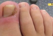 აი, როგორ მოვიშოროთ ჩაზრდილი ფრჩხილი ოპერაციის გარეშე