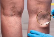 სასწრაფოდ!! ვისაც ჩაკეტილი თრომბის ნიშნები აქვს, ვურჩევთ გაეცნონ ამ ფასდაუდებელ რეცეპტებს, რომელთა დახმარებითაც პრობლემა ერთხელ და სამუდამოდ მოგვარდება..