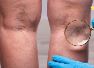 სასწრაფოდ!! ვისაც ჩაკეტილი თრომბის ნიშნები აქვს, ვურჩევთ გაეცნონ ამ ფასდაუდებელ რეცეპტებს, რომელთა დახმარებითაც პრობლემა ერთხელ და სამუდამოდ მოგვარდება..