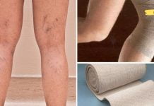 ბებოს აწუხებს ვარიკოზული ვენები ფეხებში! მან მიაგნო მეთოდს, რომლის დახმარებითაც უმკლავდება გაფართოებული ვენების პრობლემას..