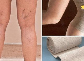 ბებოს აწუხებს ვარიკოზული ვენები ფეხებში! მან მიაგნო მეთოდს, რომლის დახმარებითაც უმკლავდება გაფართოებული ვენების პრობლემას..