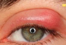 თუ თვალი ასე შეგიშუპდათ ეს სტატია აუცილებლად წაიკითხეთ!. ის შეიძლება იყოს ტრაქომა, რომელიც ბევრად საშიშია ვიდრე კონიუნქტივიტი! ეს საყურადღებოა!.