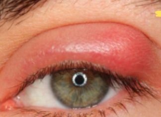 თუ თვალი ასე შეგიშუპდათ ეს სტატია აუცილებლად წაიკითხეთ!. ის შეიძლება იყოს ტრაქომა, რომელიც ბევრად საშიშია ვიდრე კონიუნქტივიტი! ეს საყურადღებოა!.