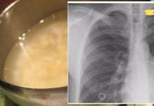 ამ სიროფით გავასუფთავე ფილტვები არასასურველი ნარჩენებისგან! ეს ბევრს გამოგადგებათ..