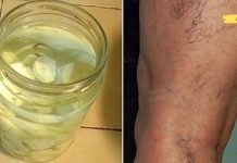 განკურნეთ ვარიკოზული ვენები ბუნებრივად: შედეგები დაუყოვნებლივ შესამჩნევია, ეს არის დიდი აღმოჩენა!