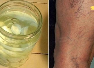 განკურნეთ ვარიკოზული ვენები ბუნებრივად: შედეგები დაუყოვნებლივ შესამჩნევია, ეს არის დიდი აღმოჩენა!