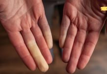 თუ გაწუხებთ სისხლის ცუდი მიმოქცევა და ცივი ფეხები, მაშინ გაეცანით მის გამომწვევ მიზეზებსა და მკურნალობის მეთოდებს