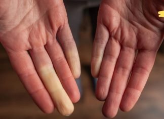 თუ გაწუხებთ სისხლის ცუდი მიმოქცევა და ცივი ფეხები, მაშინ გაეცანით მის გამომწვევ მიზეზებსა და მკურნალობის მეთოდებს