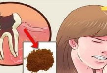 მოიშორეთ კბილის ტკივილი სახლში: „ჩემი სტომატოლოგიც კი გაოცებული იყო ამ მეთოდებით“!