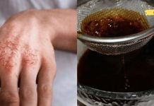 როგორ ვუმკურნალოთ ეგზემას ხალხური საშუალებებით?რეცეპტები, რომლებიც დრომ გამოსცადა!