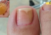 აი როგორ ვუმკურნალოთ ფრჩხილის სოკოს კვერცხის და ძმრის დახმარებით. ყველაზე ეფექტური მეთოდია!