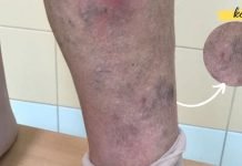 ესრეცეპტი აქრობს თრომბებს. თუ ვარიკოზი გაწუხებთ ეს უნდა გააკეთოთ!