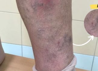 ესრეცეპტი აქრობს თრომბებს. თუ ვარიკოზი გაწუხებთ ეს უნდა გააკეთოთ!