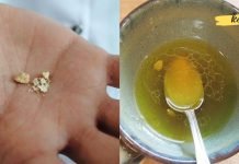 მოიშორეთ თირკმელებში ქვები ამ მარტივი რეცეპტით! მისი ეფექტიურობა დადასტურებულია!