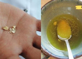 მოიშორეთ თირკმელებში ქვები ამ მარტივი რეცეპტით! მისი ეფექტიურობა დადასტურებულია!