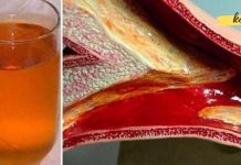 კინაღამ მოვკვდი გულის შეტევით, არტერიების დახშობის გამო. ამ წამალმა გადაარჩინა ჩემი სიცოცხლე!