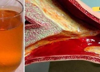 კინაღამ მოვკვდი გულის შეტევით, არტერიების დახშობის გამო. ამ წამალმა გადაარჩინა ჩემი სიცოცხლე!