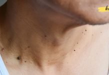 ამ ერთი ნატურალური ინგრედიენტის გამოყენებით, მეჭეჭებისგან სამუდამოდ გათავისუფლდებით !