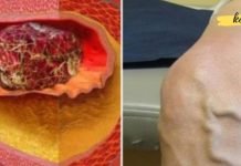 ფაფა, რომელიც ხსნის თრომბებს – ეს ხსნაა ვარიკოზული და ანთებითი ვენებისთვის