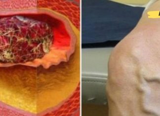 ფაფა, რომელიც ხსნის თრომბებს – ეს ხსნაა ვარიკოზული და ანთებითი ვენებისთვის