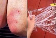 განიკურნეთ ფსორიაზისგან ამ ბუნებრივი საშუალების დახმარებით!