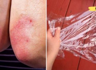 განიკურნეთ ფსორიაზისგან ამ ბუნებრივი საშუალების დახმარებით!