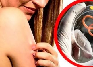 თუ ეს ნიშნები გაქვთ, ე.ი. თქვენს ორგანიზმში პარაზიტები ბუდობენ! დროულად მოახდინეთ მათი გამოდევნა!