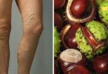 როგორ ვუმკურნალოთ ვარიკოზულ ვენებს სახლში? ეს გამოგადგებათ!