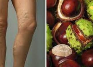 როგორ ვუმკურნალოთ ვარიკოზულ ვენებს სახლში? ეს გამოგადგებათ!